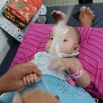 18 Orang Balita dan Dewasa Ikut Operasi Bibir Sumbing Gratis di BLUD RS Konawe