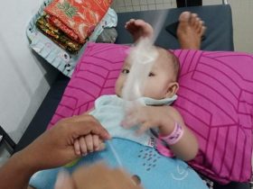 18 Orang Balita dan Dewasa Ikut Operasi Bibir Sumbing Gratis di BLUD RS Konawe